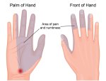 Carpal+Tunnel
